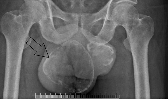 Plain X-ray pelvis showing peripheral rim of calcification of bilateral testis (arrow).